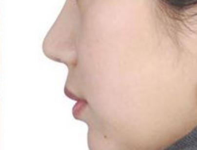 隆鼻一个月定型吗(隆鼻需要多久才能定型？)