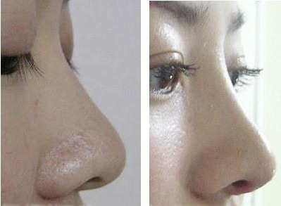 鼻子有皱纹是什么原因导致的