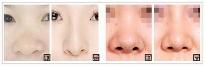 韩式隆鼻手术有什么优点呢？