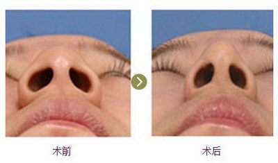 关于鼻子假体的饮食注意_硅胶隆鼻取出后鼻子会变形吗