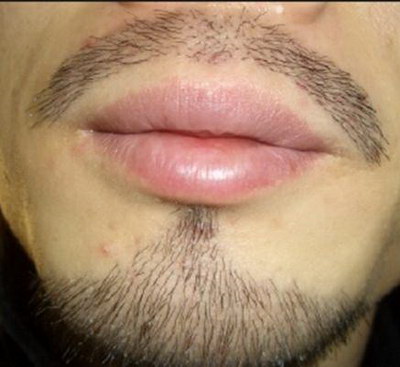 淡化胡子的方法(淡化胡子斑的方法)