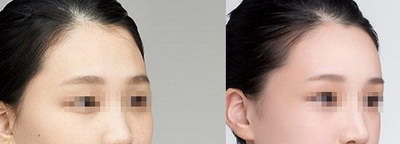 大小脸可以用瘦脸面膜矫正吗?