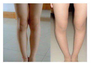 成人ox腿型矫正:如何改善骨骼畸形?