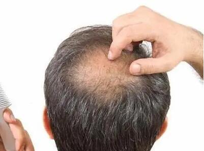 什么叫雄激素脱发「什么叫做雄激素脱发」