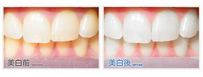 下颌第一磨牙颌面形态是什么_下颌第一磨牙颌面形态画图