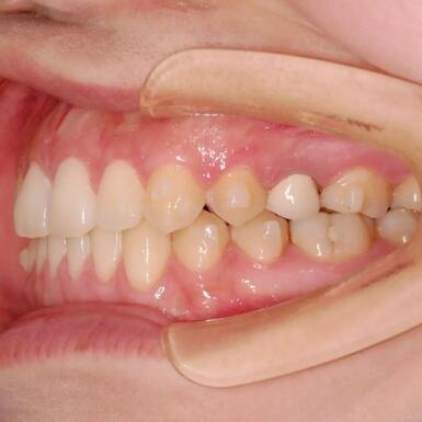 矫正牙齿有几种方法【重庆矫正牙齿有几种方法】