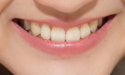 牙齿有裂缝怎么修补_牙齿有坑怎么修复