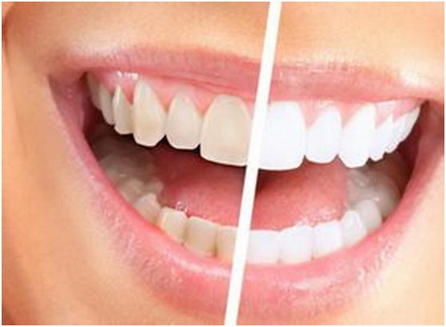 戴隐形牙套真的会有效改善牙缝大吗