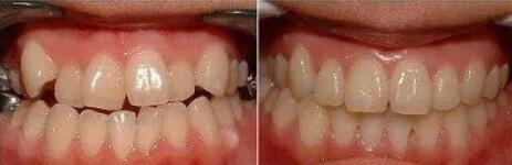 牙龈病中最常见的疾病是