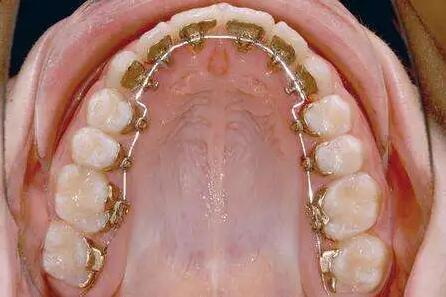 牙龈肿痛怎么消肿最快「戴牙套后牙龈肿痛怎么消肿」