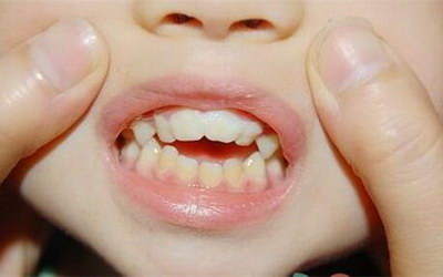 引起牙龈敏感的原因是哪些_牙齿变黄牙龈萎缩