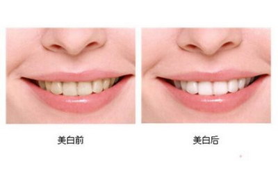 盐有助于解决牙黄问题_门牙白两侧牙黄怎么回事