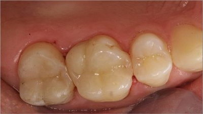 带牙套牙龈萎缩会恢复吗