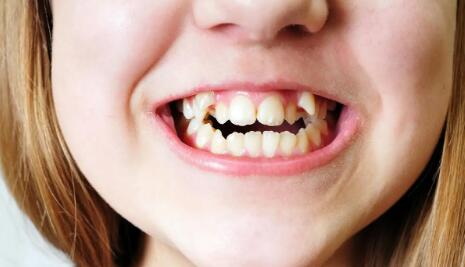 光敏树脂补牙能用多久