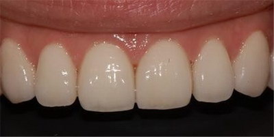 全口活动义齿什么材料的比较好_吸附性义齿和活动假牙有啥区别