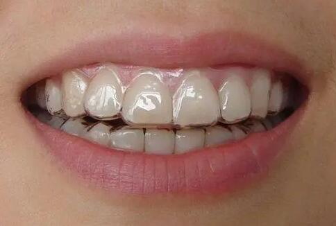 牙齿上的牙龈萎缩(牙龈萎缩严重能种植牙齿吗)