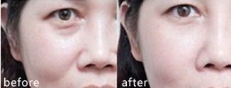 双眼皮脂肪填充后几天可以洗脸(手术后该如何保养伤口)