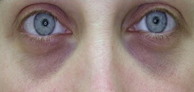 双眼皮恢复期过程(双眼皮手术恢复期过程)