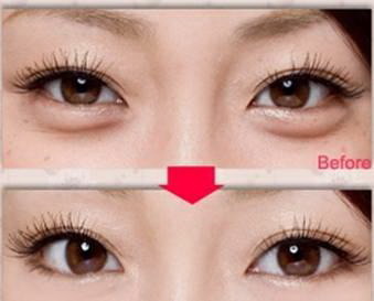 双眼皮线很浅的人群适合做哪种双眼皮呢？