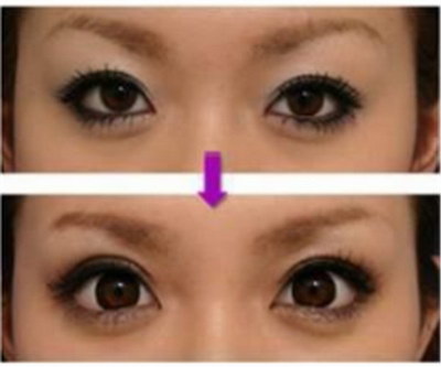 开眼角留疤后多久可以进行修复_开眼角术后留疤痕怎么办