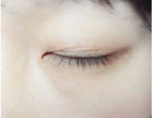 什么是韩式双眼皮手术(什么是韩式双眼皮手术韩式双眼皮)