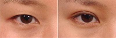 女士的眼皮产生下垂应该如何诊治？