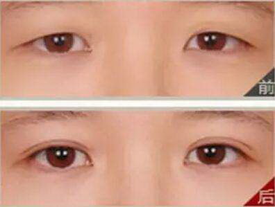 韩式双眼皮大概需要多久的恢复时间？