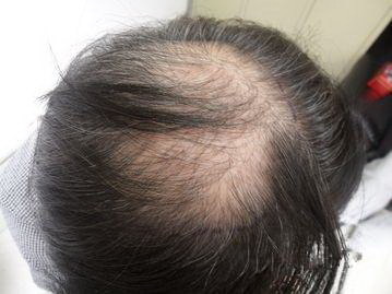 植发多久进入生长期_有疤痕的地方可以植发吗