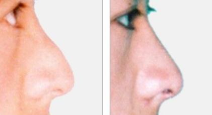六种鼻形的整形方法都了解吗?