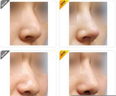 做胶原蛋白隆鼻的正确护理方式是什么？