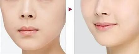 鼻综合鼻头凹陷(鼻头凹陷的治疗方法)