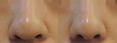 鼻子硅胶和膨体的区别_膨体做的鼻子 管多久