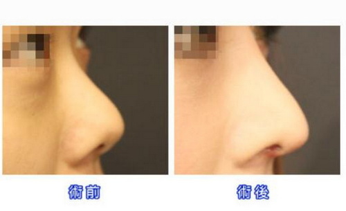 假体隆鼻有哪些手术方法？
