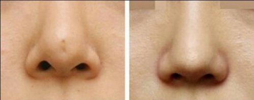 鼻子的完美标准表现是什么呢？