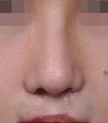使用硅胶假体隆鼻的价格是多少？