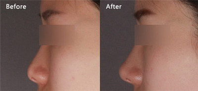 假体隆鼻术后多久能洗脸？
