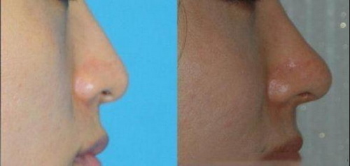 鼻子整形拆线后要注意什么_耳软骨鼻子恢复自然需要多久?