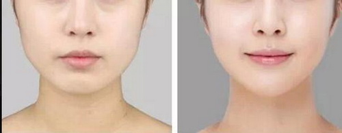 你知道驼峰鼻纠正手术怎么做吗？