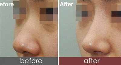 整容可否整鼻子玻尿酸隆鼻有哪些优缺点？