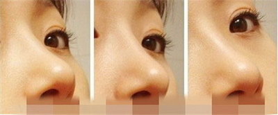 达拉斯鼻整形术的知识与技术_达拉斯鼻综合是什么