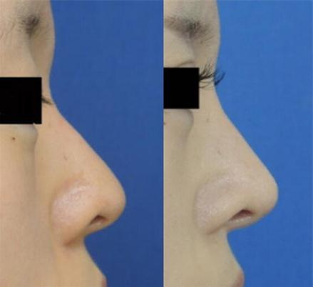 隆鼻假体更换容易吗_隆鼻假体硅胶和膨体哪个好