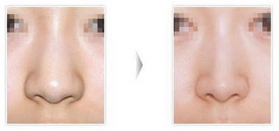 鼻子整形有哪些类型(鼻子整形分为哪些类型)