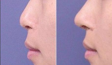驼峰鼻矫正有什么步骤？