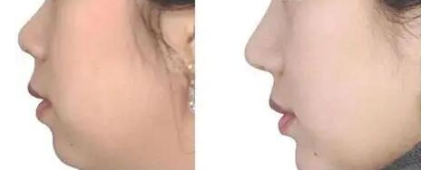 适合硅胶假体隆鼻的鼻形有哪些？