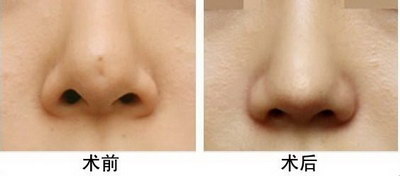流行的几种隆鼻术都有什么？