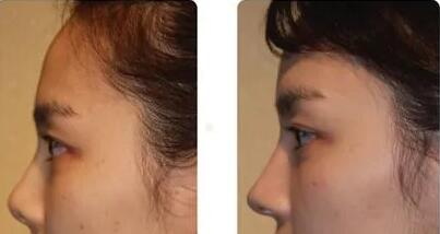 硅胶鼻子可以维持多久_肋骨硅胶鼻子多久自然