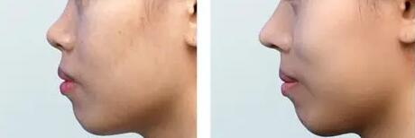 综合鼻整形一侧鼻翼切多了怎么办_鼻翼整形完成后是否能够做综合鼻整形?