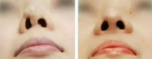 隆鼻拆完线后几天能洗脸_隆鼻拆线 – 如何确定最佳时机?