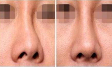 硅胶隆鼻怎么护理_硅胶隆鼻拆线后多久可以洗脸