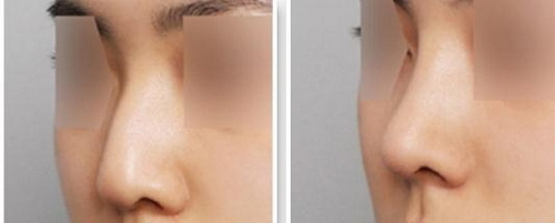 所做的假体隆鼻术后需要注意什么？